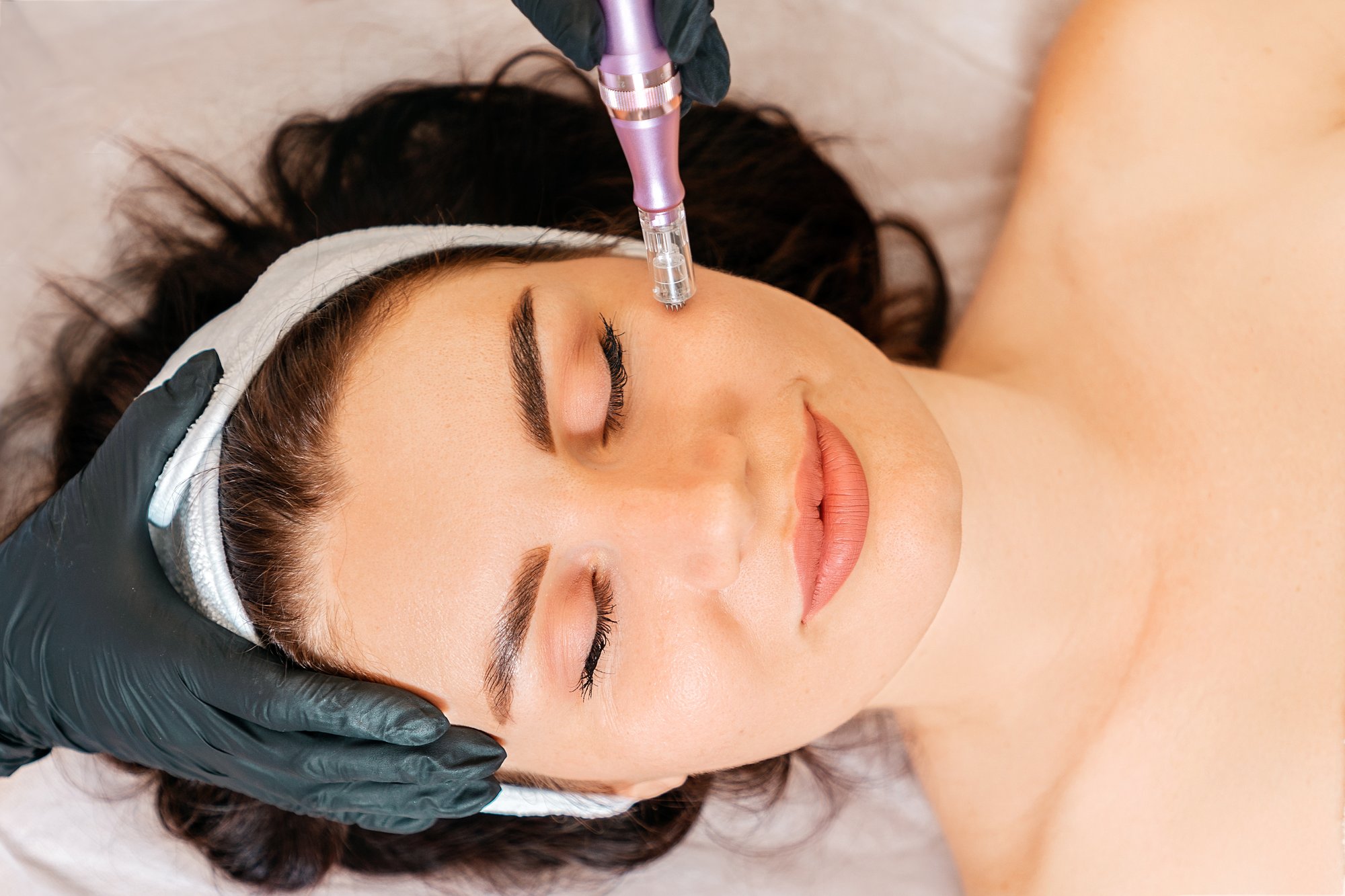 Microneedling-Behandlung bei Touch of Beauty Studio für strukturelle Hautverbesserung